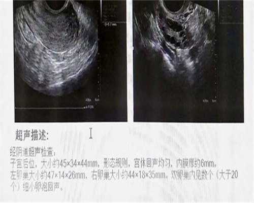 成都单身女性不育咨询实录：供卵助孕的真实体感与成功经验